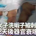 中國女子洗蝦子被刺到12天後器官衰竭死