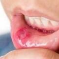 吃水果能治好口腔潰瘍嗎？營養師：3種原因會加重你的口腔潰瘍