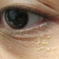 眼睛周圍的小粒粒，真是眼霜惹的禍？最好的消除方法是……