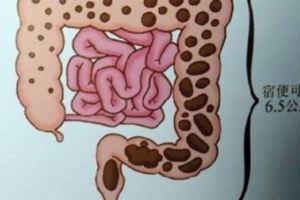 想知道自己有沒有宿便嗎？？一分鐘檢查教學輕鬆防治大腸癌~要告訴身邊朋友！