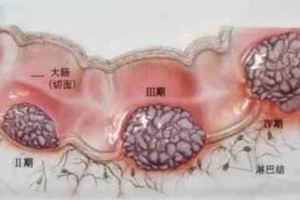 23歲女孩吃宵夜吃出腸癌！只吐不拉還有東西轉移卵巢