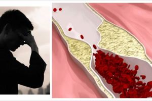 腦血管90%堵塞險癱瘓，未支架堅持喝1物，5年後血管正常了！