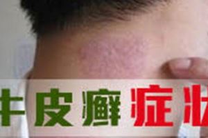 銀屑病的你只需一把葉子—6大功效助你淨化血液，遠離皮屑困擾