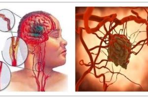 45歲以後，十年「生命高危期」期間，兩種病最可怕