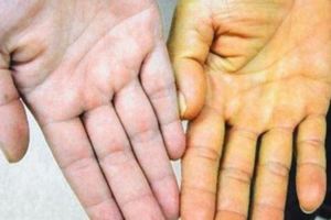 皮膚和眼睛變黃，可能是身體哪塊出了問題？