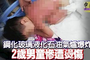 鋼化玻璃液化石油氣爐爆炸2歲男童慘遭燙傷