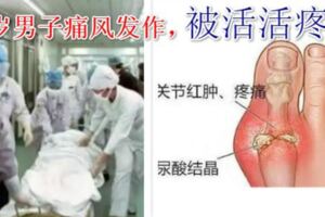 53歲男子被活活疼死！痛風有多痛？這些食物一定要忌口！