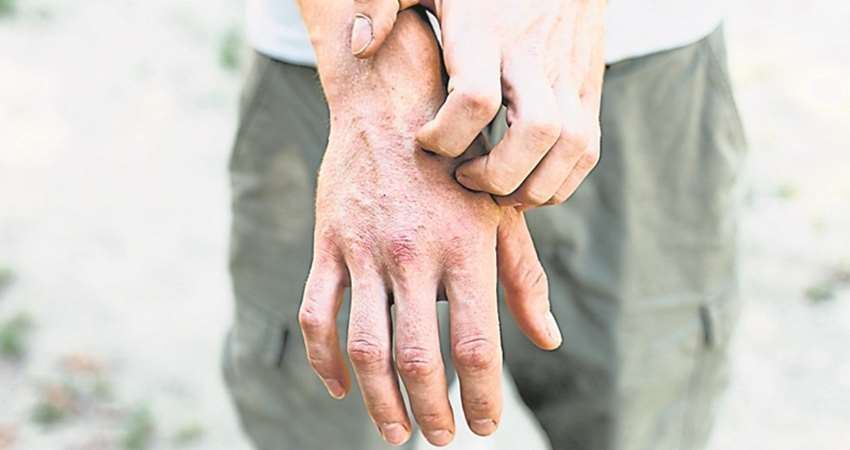 皮蛇 蕁麻疹 過敏都跟你的免疫力有關 一旦失調 8大疾病 恐怕找上門 愛上世界分享愛 Fun01 創作分享