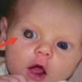 小男孩從小有「雙色瞳孔」，父母覺得漂亮但兩歲時醫生檢查發現眼中長著一堆「髒東西」！