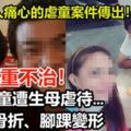 傷重不治！6歲男童遭生母虐待…四肢骨折、腳踝變形