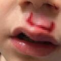 父母亂玩指尖陀螺「造成兒子的臉被炸到縫30針」，這種玩具已經讓許多家長受驚、孩子受傷！