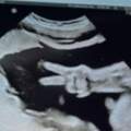 醫生在拍！媽媽產檢「胎兒突然比YA」　奇蹟超音波照曝光