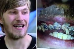 這個男子「20年來完全沒有刷過牙齒」，他一張開嘴巴連牙醫也後退300步！