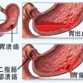 消化性潰瘍怎麼辦？調節心情、釋放壓力、合理飲食才是關鍵！