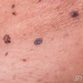 自查：皮膚上的痣有5個特徵，說明皮膚癌在靠近！