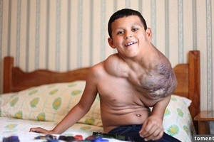 這名男孩的頸部天生就長了一個巨大的腫瘤，據醫生的說法，這就是所謂的OOO瘤，而這個疾病已經開始威脅他的生命...