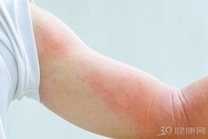 為什麼好好的皮膚會長蕁麻疹？這6個因素是「原罪」！