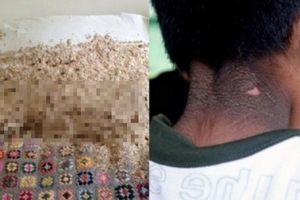 6歲男童罹患恐怖「面板皮膚病」 原因竟在床底下