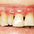 牙周炎會通過唾液傳播嗎？專家告訴你引起牙周炎的主要因素