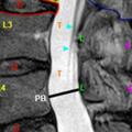 （收藏）腰椎MRI怎麼閱片呢？腰椎間盤突出如何看？零基礎可讀懂