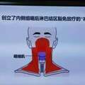中國團隊創新「減毒」技術 99%鼻咽癌患者將從中受益