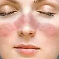 女子旅遊高燒不退確診「不死癌症」 紅斑狼瘡，醫生：陽光照射會誘發病情，還要避免化妝、美甲和燙染髮