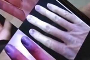 江蘇女子遇冷手指就發白變紫 醫生科普：免疫系統出問題