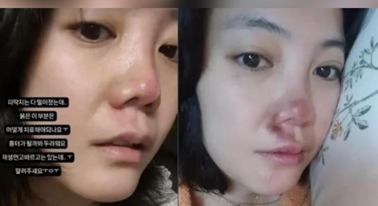 高恩雅最近跌倒,鼻子又毀容。(圖/翻攝自IG) 高恩雅最近跌倒,鼻子又毀容。(圖/翻攝自IG)