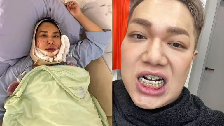 關韶文首次手術後戴了1年牙套,沒想到齒列依舊走位。(圖/翻攝自關韶文IG) 關韶文首次手術後戴了1年牙套,沒想到齒列依舊走位。(圖/翻攝自關韶文IG)