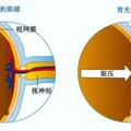中醫眼裡的「致盲殺手」青光眼