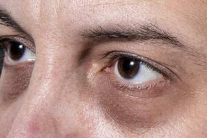 揭秘黑眼圈的成因及預防方法