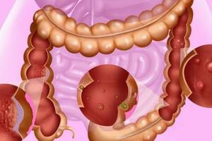 為何腸道容易長「息肉」？腸內若有息肉，身體會有什麼症狀？