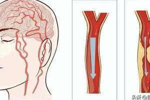 關於腦卒中，這是一篇最全科普