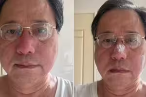 有夠慘！被蜂螫鼻樑曬照嘲「腫脹似豬八戒」 李來希：腫到人臉辨識失靈