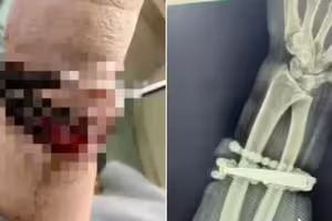 女子戴手鐲10年不摘！「嵌進肉裡」醫嚇傻