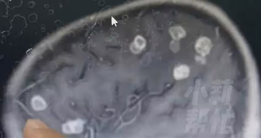 大掃除完…6歲女童高燒17天！檢查驚「腦袋被啃20個洞」元凶曝光