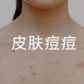 雞皮橡皮擦Stridex施顏適水楊酸棉片XL版到底有多好用？