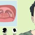 咽炎怎麼治療能除根，你知道嗎？