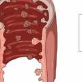 長了腸息肉，到底要不要切？腸息肉和腸癌有什麼關係？不妨了解