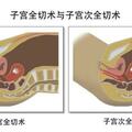 子宮切除的利弊是什麼？