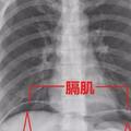 女子腹痛，X片顯示隔下游離氣體，診斷胃腸道穿孔，馬上手術