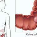 腸道「定時炸彈」-腸息肉，必須要切除嗎？什麼樣的息肉會癌變？