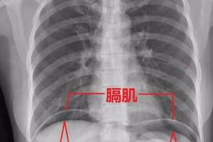 女子腹痛，X片顯示隔下游離氣體，診斷胃腸道穿孔，馬上手術