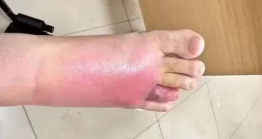 沙發睡一覺　男子腳掌竟變超腫！險截肢原因曝