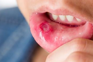 7種馬上治癒超痛嘴破的神奇方法。 