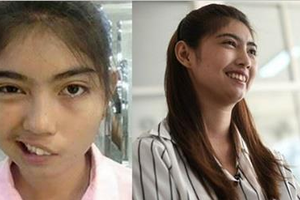 泰國這名18歲少女因被老師用馬克杯擊中頭部，導致左臉頰癱瘓，她卻笑著這麼說... 