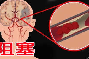 99％的人不知道，吃這水果，才能真正「預防中風」！轉載一次救人一命！！15