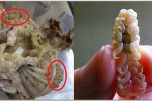 驚！6歲孩童因生吃螃蟹，檢查發現體內藏有5000多條寄生蟲，而且大腦被吃掉了一個洞！！太嚇人！ 