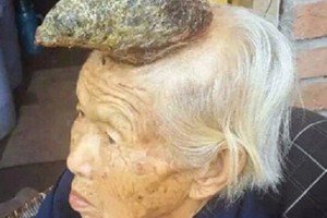 87歲阿嬤「頭長出角」被稱為「獨角獸女人」！找醫生把它切掉卻發生「驚人一幕」！原來這個角是… 