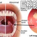  「扁桃腺」反覆發炎看不好？多喝三種天然飲料，活化細胞遠離咽喉疼痛。